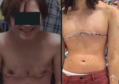 Mastectomías y hormonas, los objetivos de las chicas que se autodeterminan como transgénero